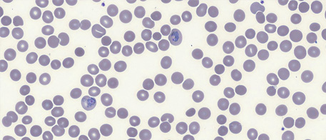 Digital thin smear preparation Digital thin smear preparation